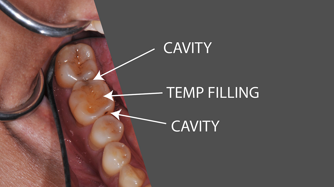 how long does it take to fill a cavity